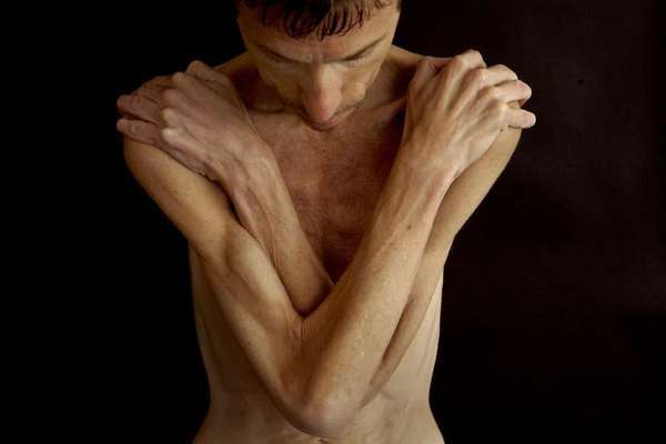 Anoreksiya Nervoza Nedir Saglik Haberleri