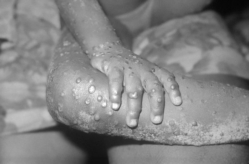 Maymun Çiçeği Virüsü Monkeypox Nasıl Korunuruz ve Tedavi Yöntemleri Nelerdir?